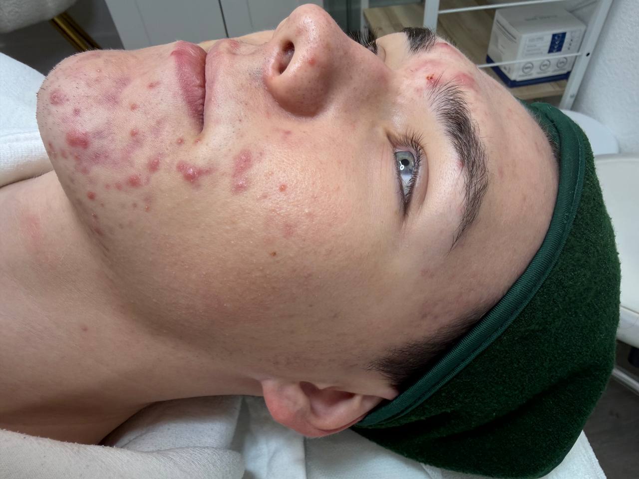 Skin at H.A. Skin Lab, treatment photo