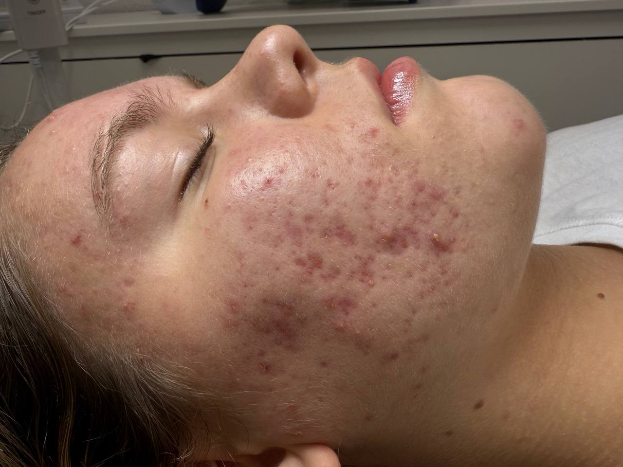 Skin at H.A. Skin Lab, treatment photo