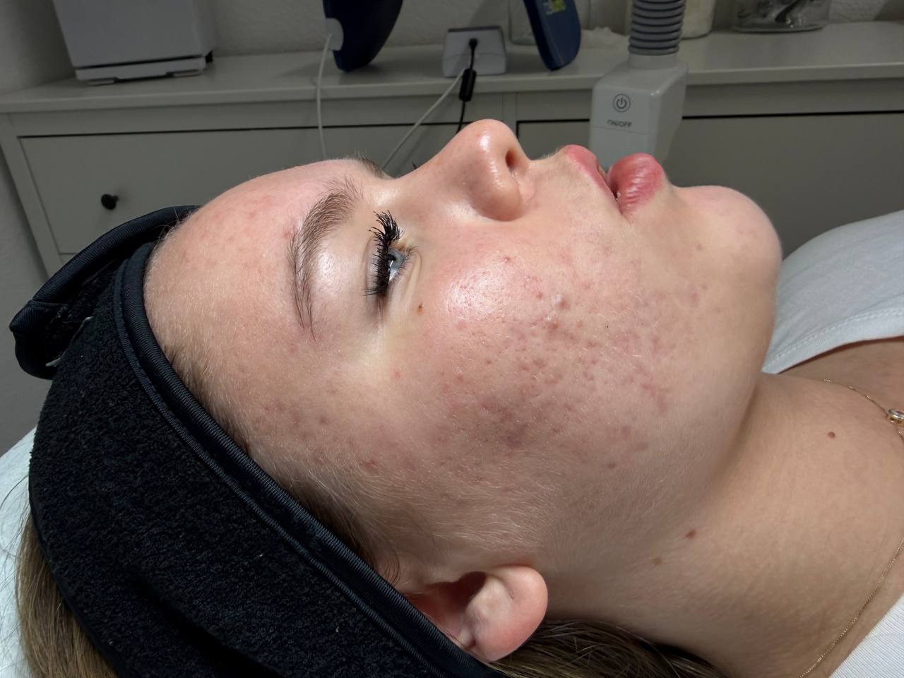 Skin at H.A. Skin Lab, treatment photo