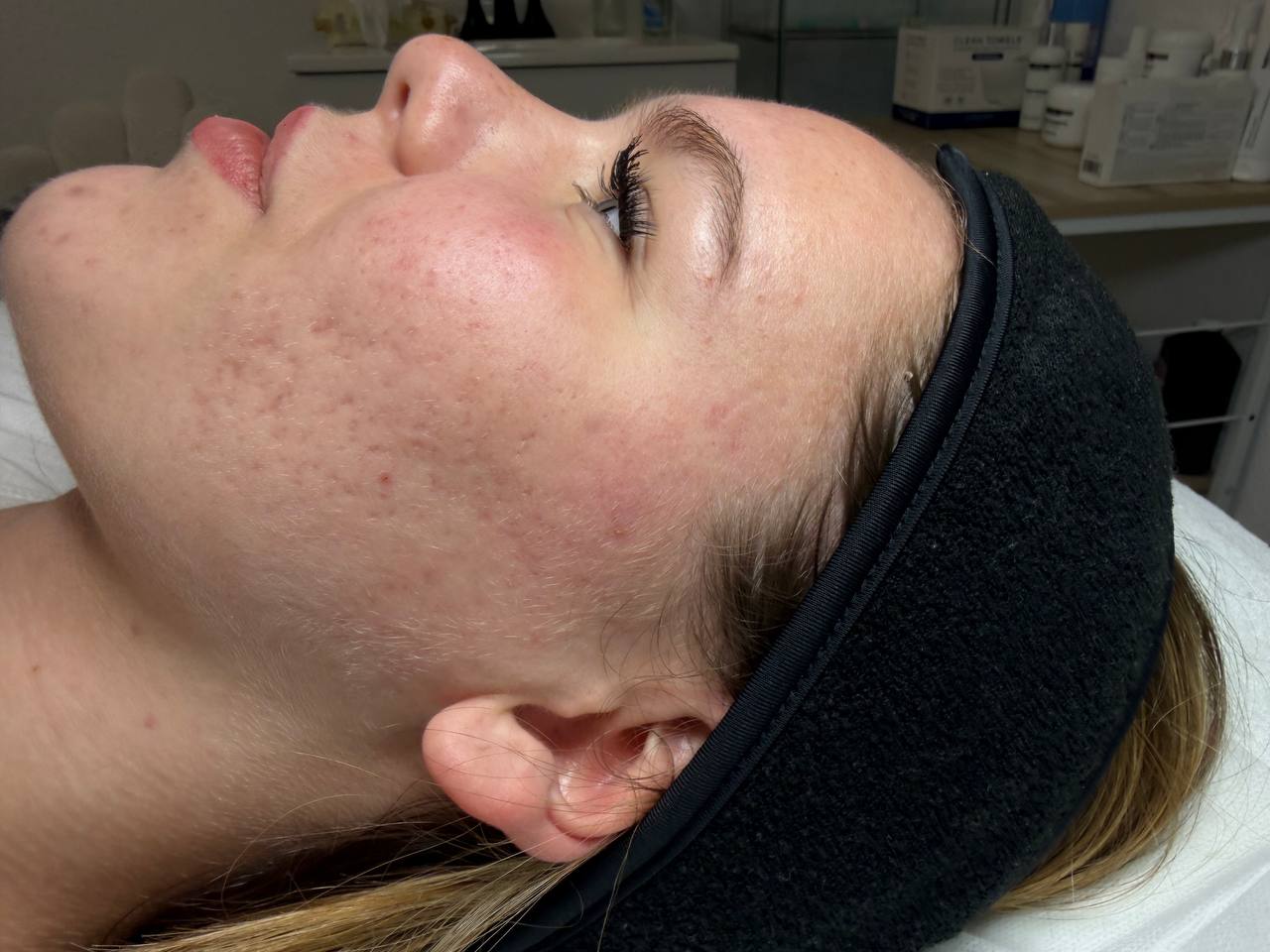Skin at H.A. Skin Lab, treatment photo