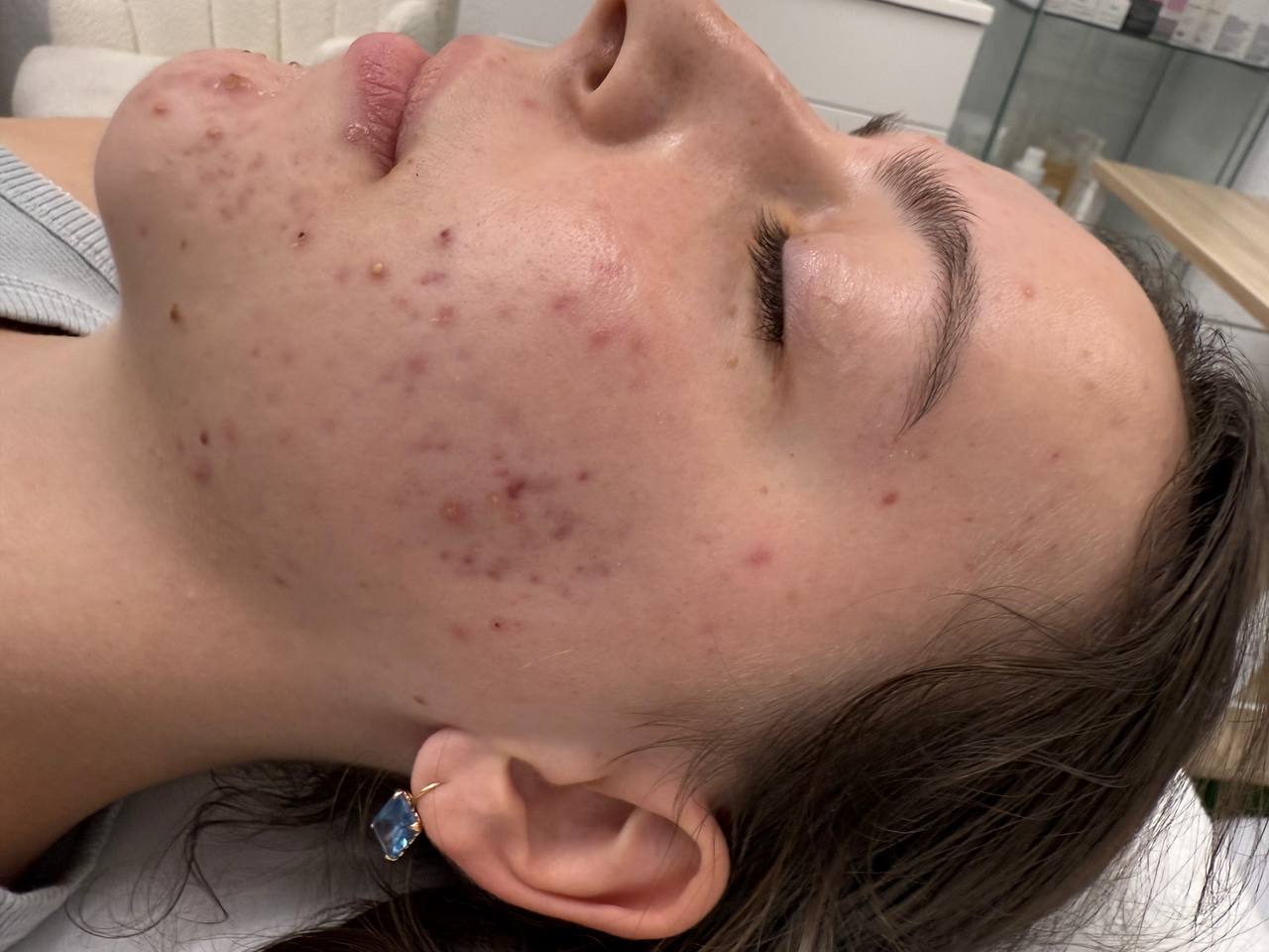 Skin at H.A. Skin Lab, treatment photo