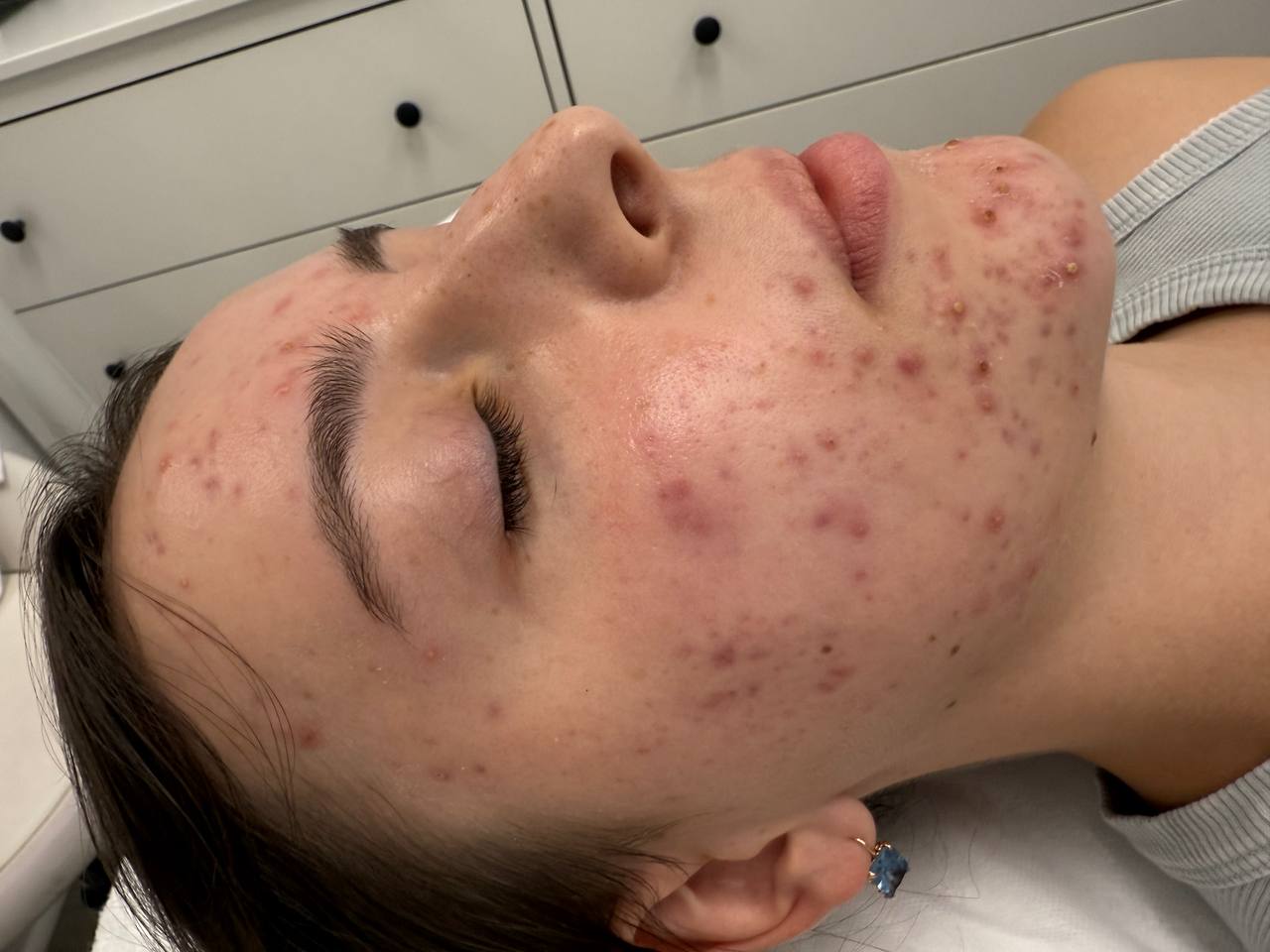 Skin at H.A. Skin Lab, treatment photo