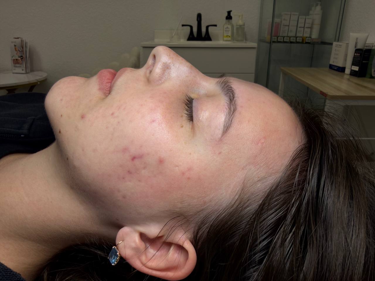 Skin at H.A. Skin Lab, treatment photo