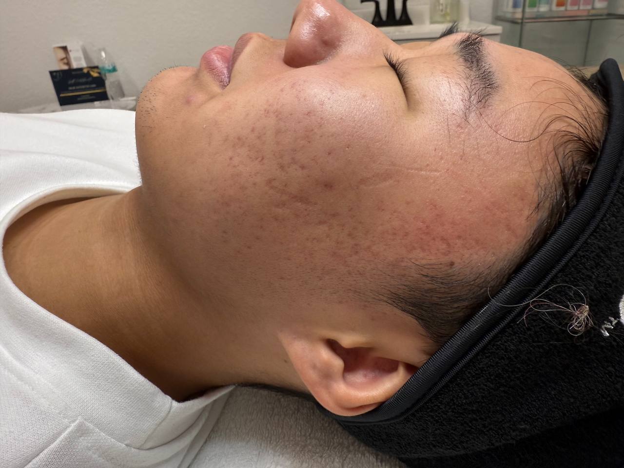 Skin at H.A. Skin Lab, treatment photo