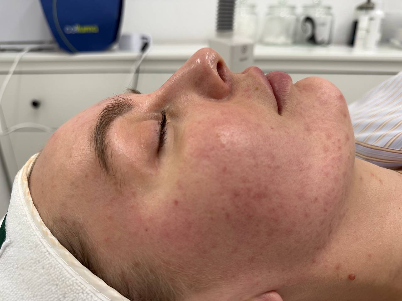 Skin at H.A. Skin Lab, treatment photo