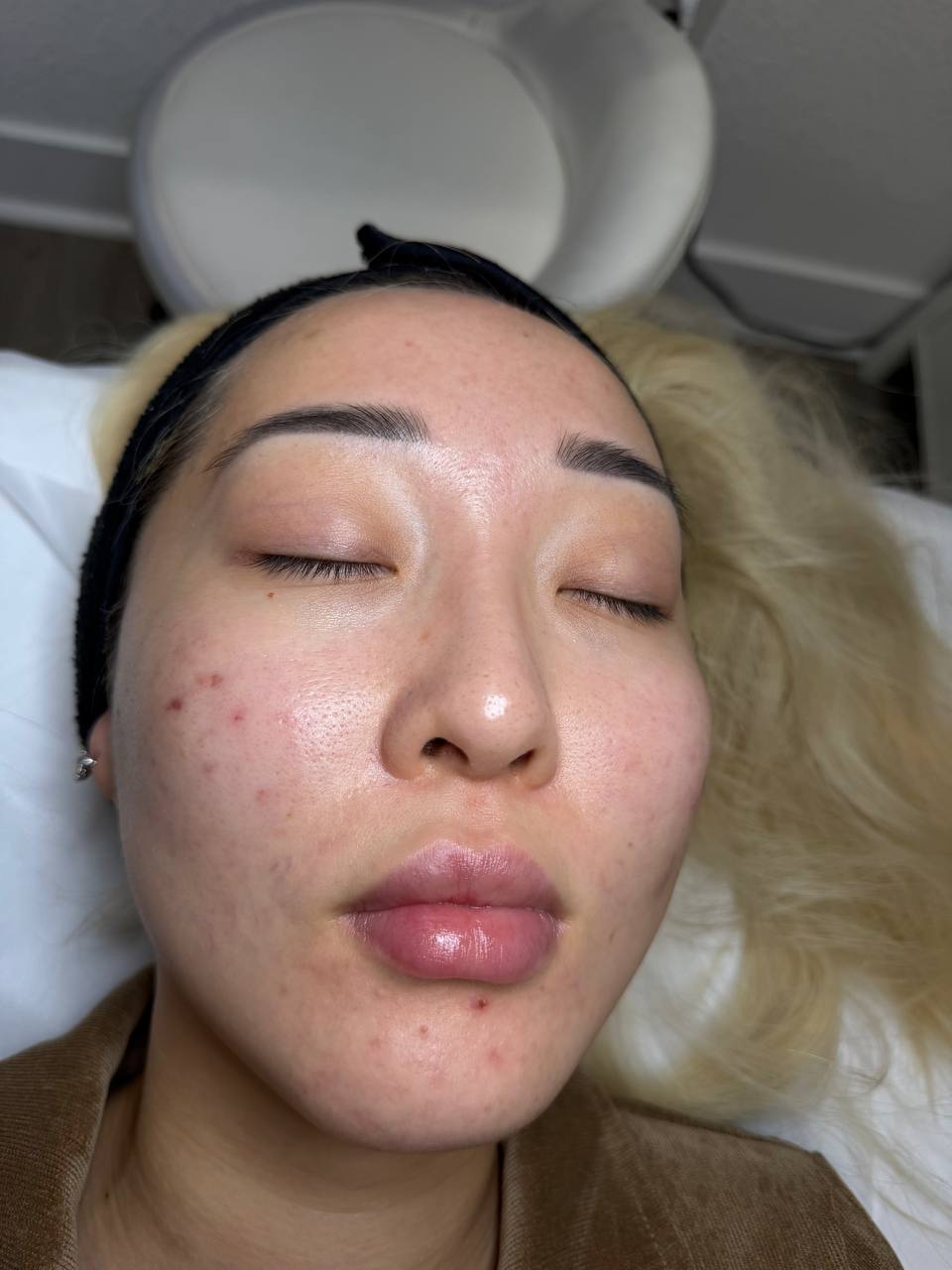 Skin at H.A. Skin Lab, treatment photo